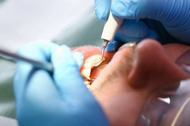 Best Emergency Tooth Extraction in Tea, SD